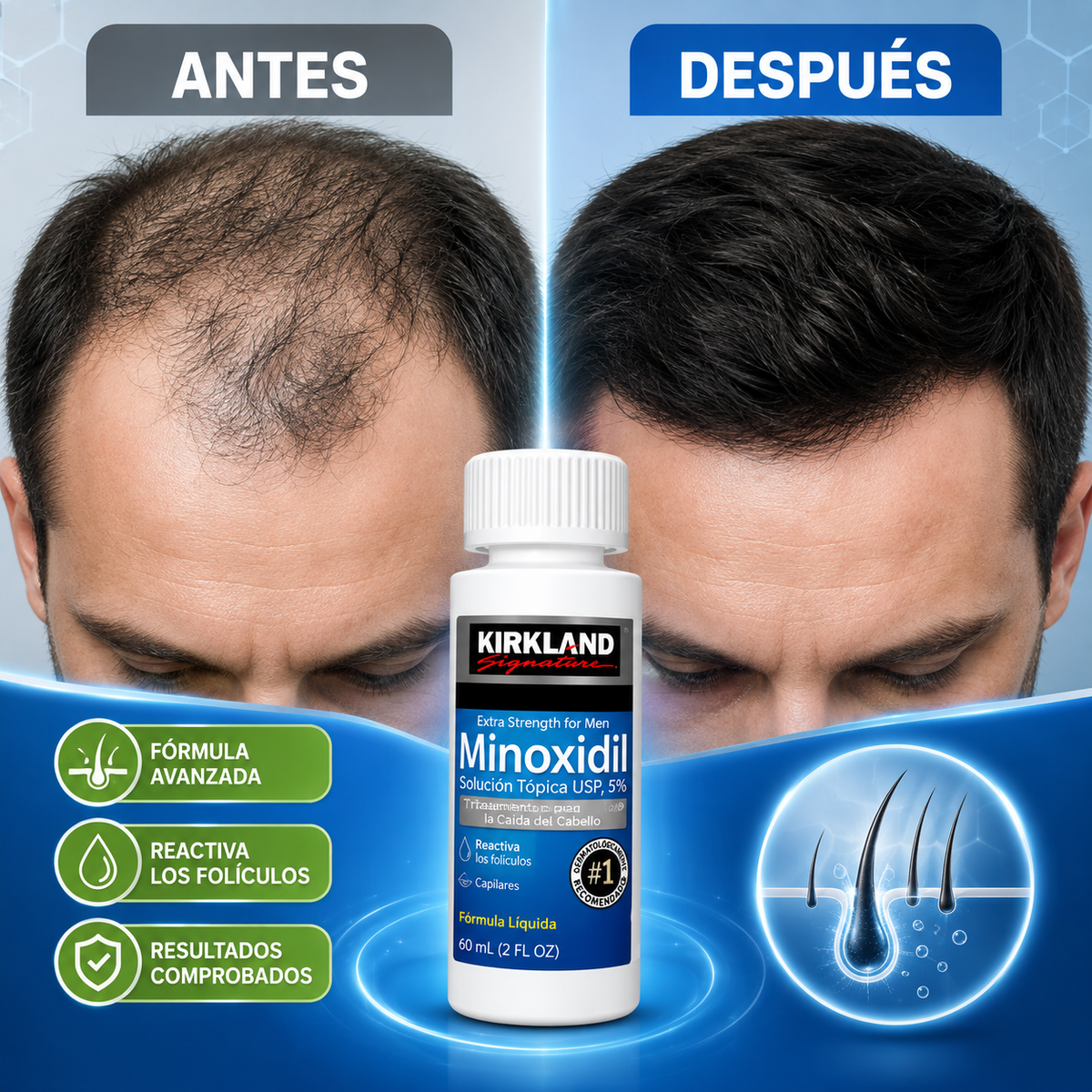 Minoxidil Kirkland + Dermaroller | Pack Cuidado Capilar para Cabello y Barba